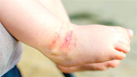 Early Onset Of Atopic Dermatitis Linked To Poorer Control Mdedge