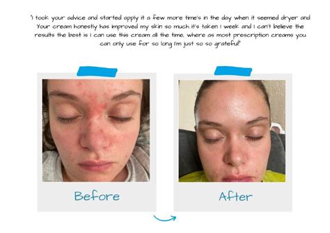 Makeup Tips For Rosacea Prone Skin Grahams Natural Uk