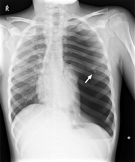 Spontaneous Pneumothoraces In Hereditary Multiple Exostoses Archives
