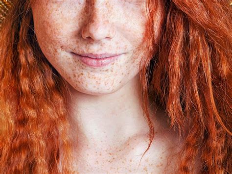 Variants Of Redhead Gene Up Melanoma Risk Even Without Sun