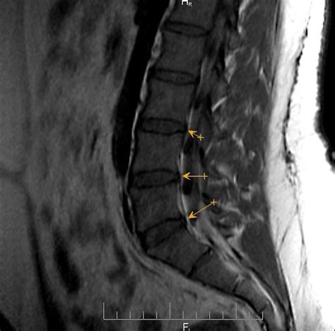 Lumbar Spine L5s1 And L4l5 Intervertebral Disc Protrusions Often