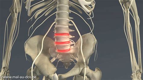 Comment Soigner Une Sciatique Par Hernie Discale L4 L5 L5 S1