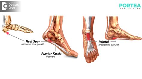 What Is Plantar Fasciitis And Heel Spur Portea Medical Youtube