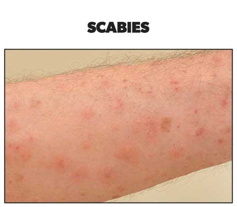 18 Acute Skin Rashes For Nurses To Know With Pictures Health And