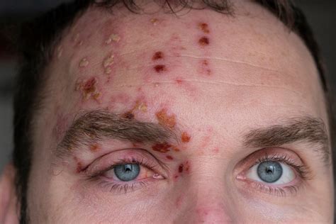 Shingles Vaccine Causes Treatment And Diagnosis