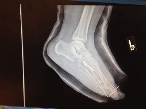 Treating An Acute Lisfranc Fracture With Orif