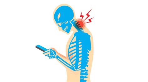 Text Neck Cause Symptoms Diagnosis Treatment Exercise Mobile P