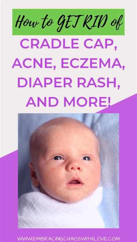 Naturally Get Rid Of Cradle Cap Diaper Rash And More Newborn Rash