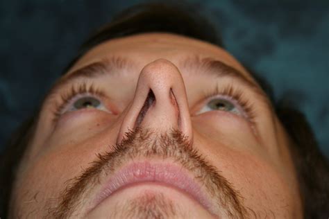 Septoplasty In Beverly Hills Deviated Septum Reconstruction