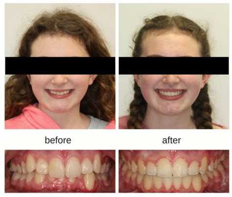 Braces Before And After Overbite