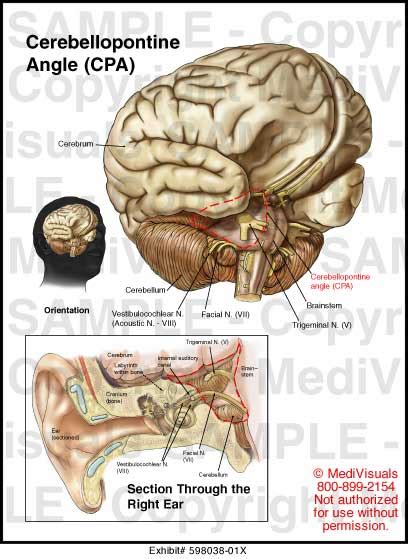 Cerebellopontine Angle (CPA) Medical Illustration Medivisuals