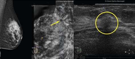 adding 3d automated breast ultrasound to mammography screening in women with heterogeneously and