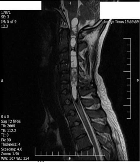 Sagittal T2 Weighted Mri Without Contrast Showed Heterogeneous High