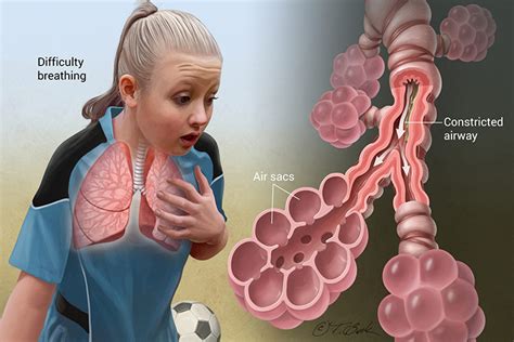 Asthma Types Risk Factors Pathophysiology Signs And Symptoms And Management