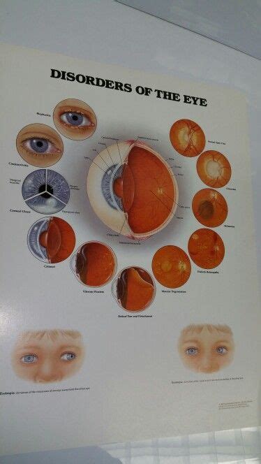 Disorders Of The Eye Chart Eye Chart Medical Anatomy Disorders Eyes