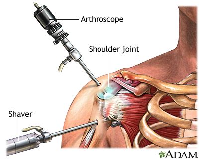 Shoulder Arthroscopy Information Mount Sinai New York Rotator Cuff Exercises Rotator Cuff