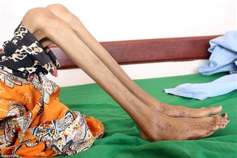 Twelve Year Old Girl Weighs Just 22lbs As Yemen S War Drives People To The Brink Of Famine