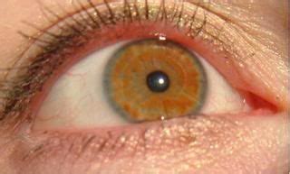 Overview Of Eye Color Depictions Youth Medical Journal Pin By Stephanie On Eye Color Goals Eye