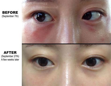 Vitamin E Oil Skin Before After