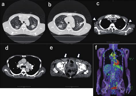 Chest and abdominal computed tomography (CT) scan and 18... | Download Scientific Diagram