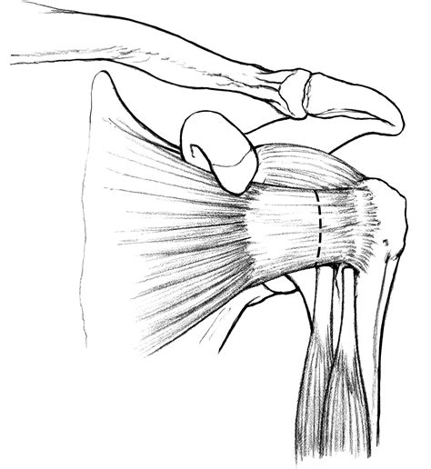 Biomechanical Comparison Of Lesser Tuberosity Osteotomy Versus