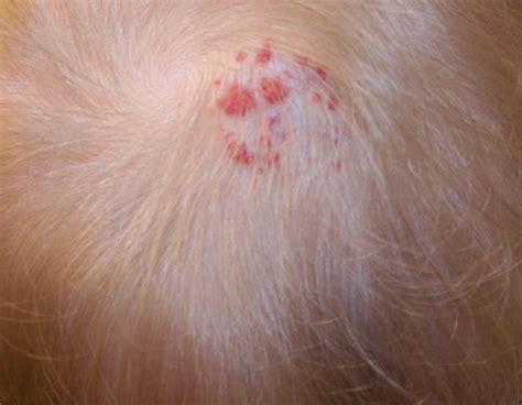 👉 Itchy Bumps On Scalp Treatment Pictures Symptoms Causes
