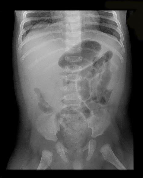 Abdominal X Ray Showing Small Bowel Obstruction Download Scientific