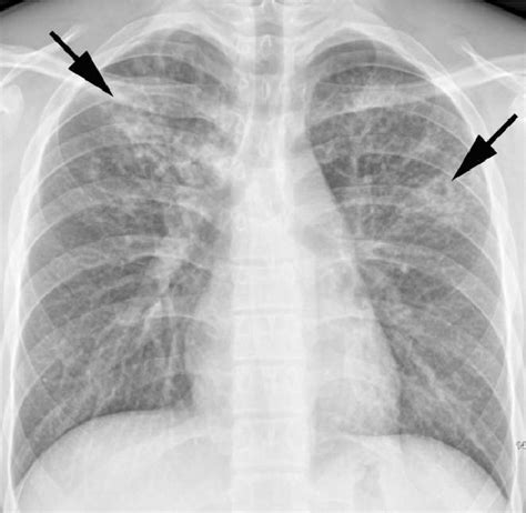 Primary Pulmonary Tuberculosis In Year Old Boy With Typical