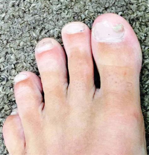 Before And After Pics Using Terbinafine Toenail Fungus