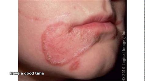 Bacterial Infection On Face Pictures Photos