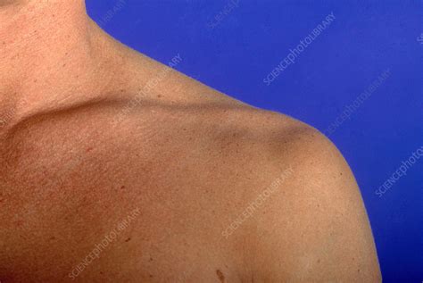 Male Shoulder Stock Image C0034458 Science Photo Library