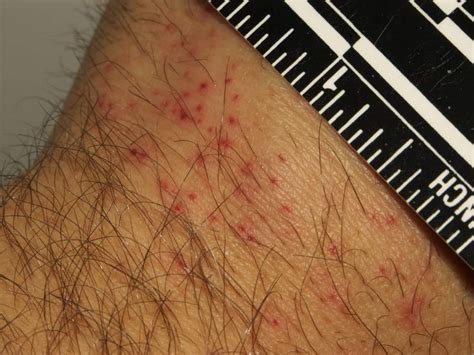 Bed Bug Rash Symptoms And Treatment Pestseek