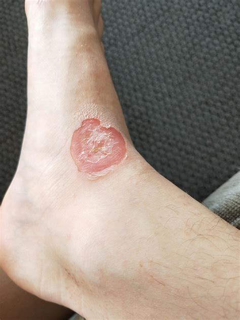 I Got A Huge Blister On My Foot Thats Infected With Staph I Have Been