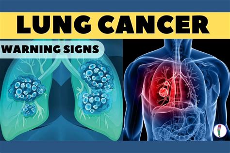 Lung Cancer Warning Signs Early Detection Tips Medinaz Blog