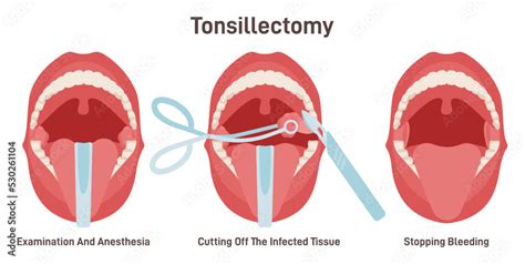 Tonsillectomy Acute Pharyngitis Treatment Surgical Removal Of The