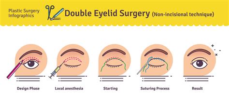 Double Eyelid Surgery In Korea Seoul Guide Medical
