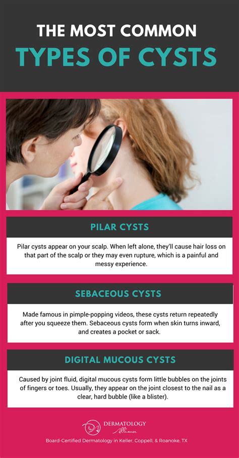 Most Common Types Of Cysts Graphic Epiphany Dermatology