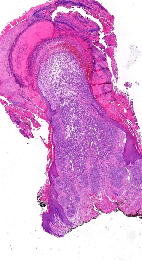 Pathology Of Pyogenic Granuloma