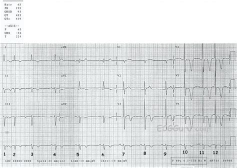 We use it when we miss something or someone we haven't seen for a long time or even we have no chance to see them. Leerobso: T Inversion Ecg
