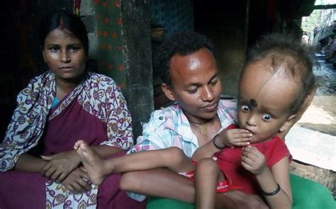 Burdwan Baby With Enlarged Head Draws Peoples Curiosity India News