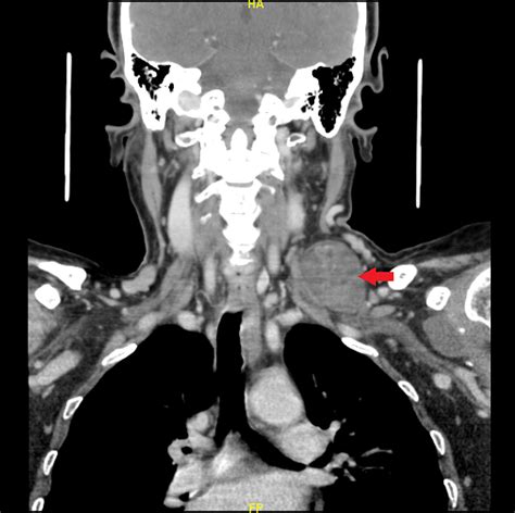 Cureus Supraclavicular Cervical Schwannoma A Case Report