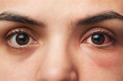 How Long Does Pink Eye Or Conjunctivitis Last All About Vision