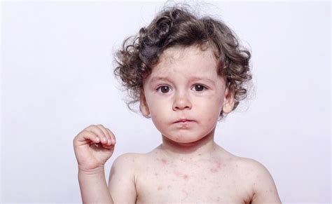 Measles Under The Microscope Facts And Figures About The Infectious Disease