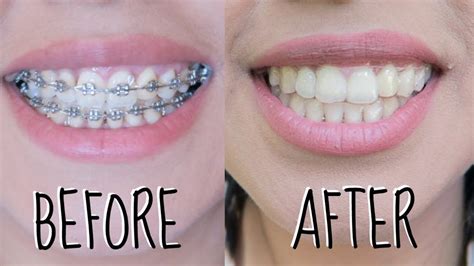 Dental Braces Before And After New Pictures After Braces Teeth
