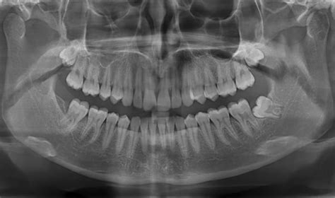 Wisdom Teeth Vc Dental