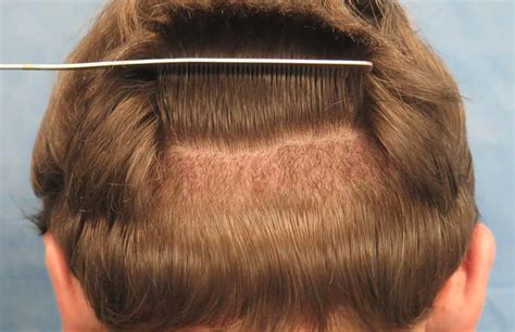 You wanted to know how does a hair transplant work? FUE Hair Transplant Procedure: How to Sleep After This ...
