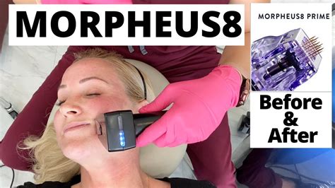 Morpheus8 Treatment Before And After Microneedling Radiofrequency