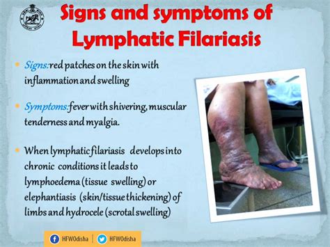 Lymphatic Filariasis Hydrocele