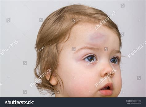 Large Bump On Childs Forehead Baby Stock Photo 1928319656 Shutterstock