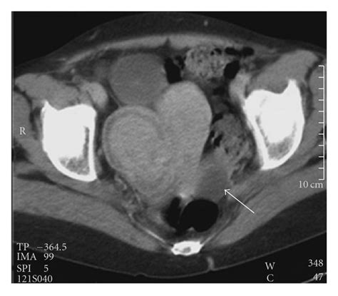 contrast enhanced ct of the pelvis showing a large myoma on the right download scientific